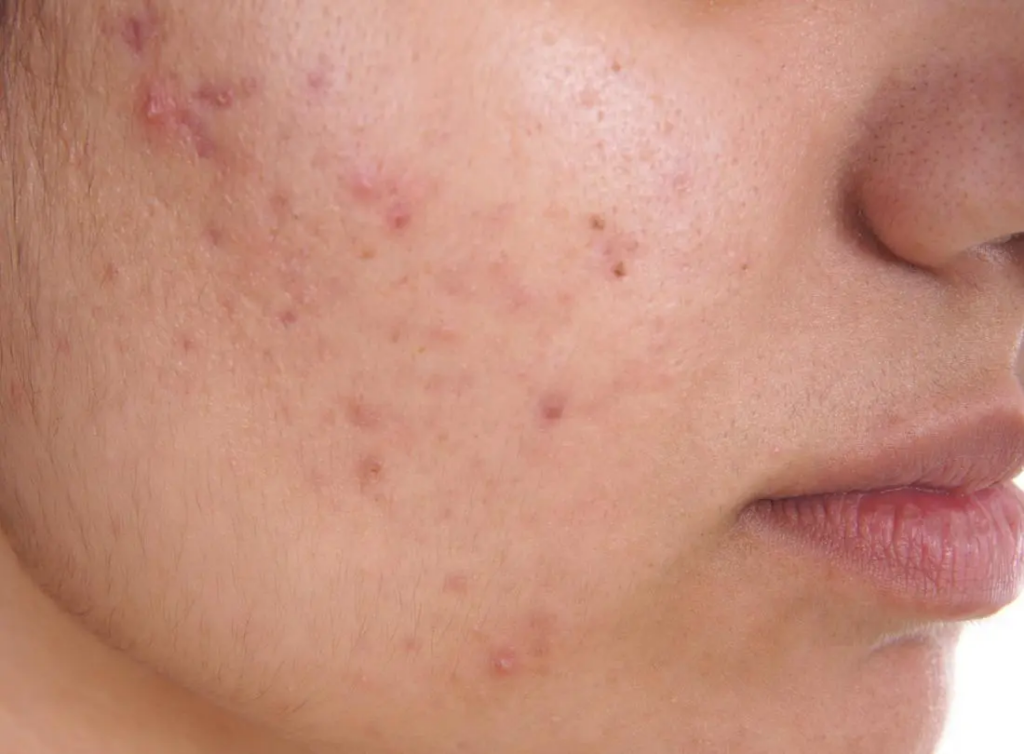 A guide to the treatment of acne